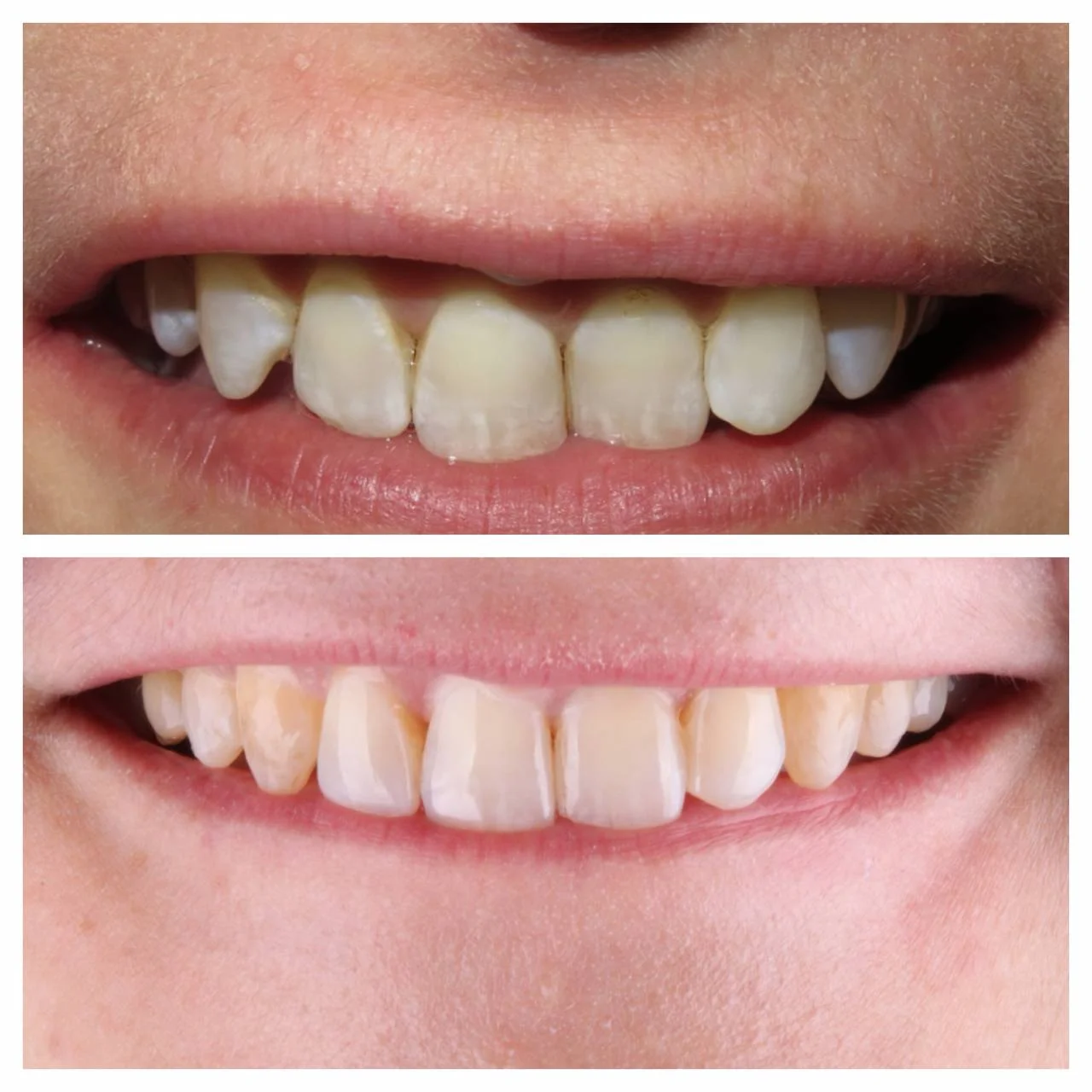 Case 2 — front tooth chip rebuilt with porcelain veneer. Before and after. Photography by Dr. Koppelman, Midtown Manhattan.