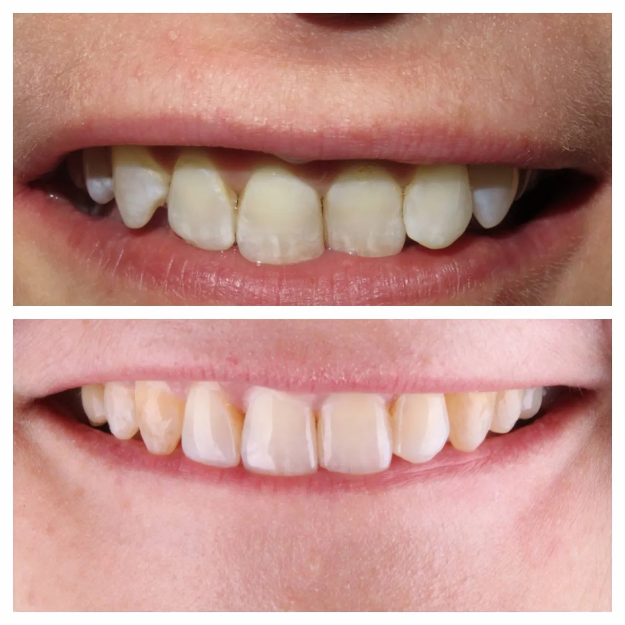 Front-tooth chip rebuilt; shade brought back to the rest of the face.