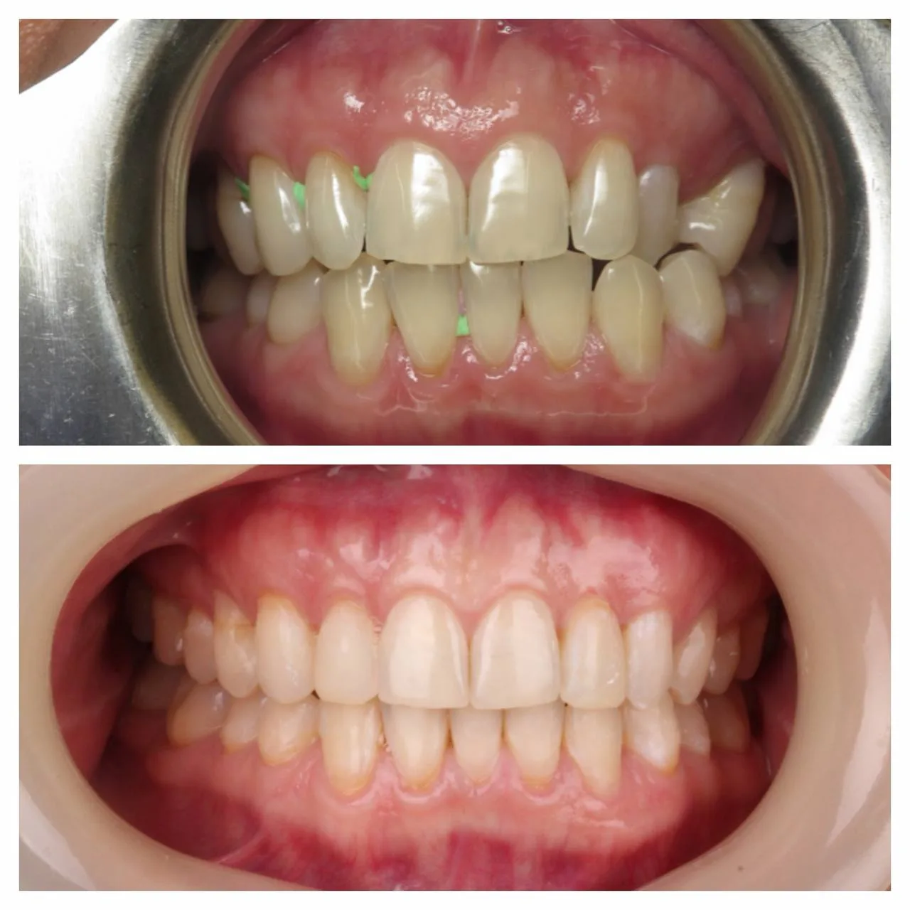 Invisalign and whitening — a conservative result without enamel touched.