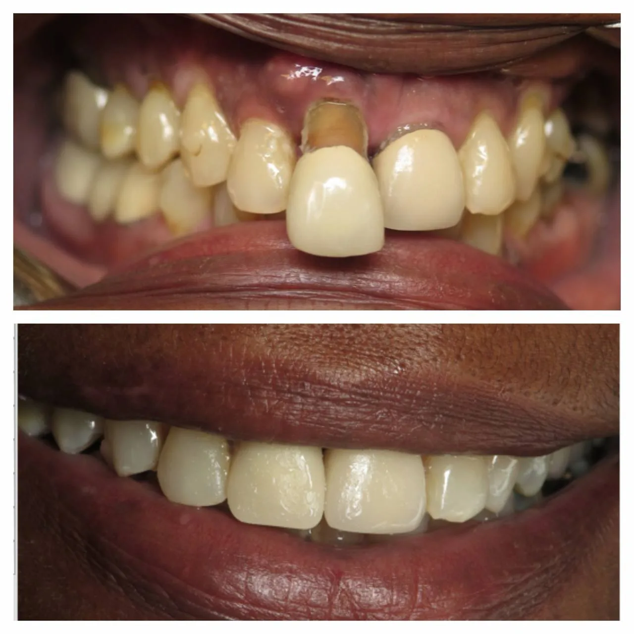 Full-mouth implant restoration.