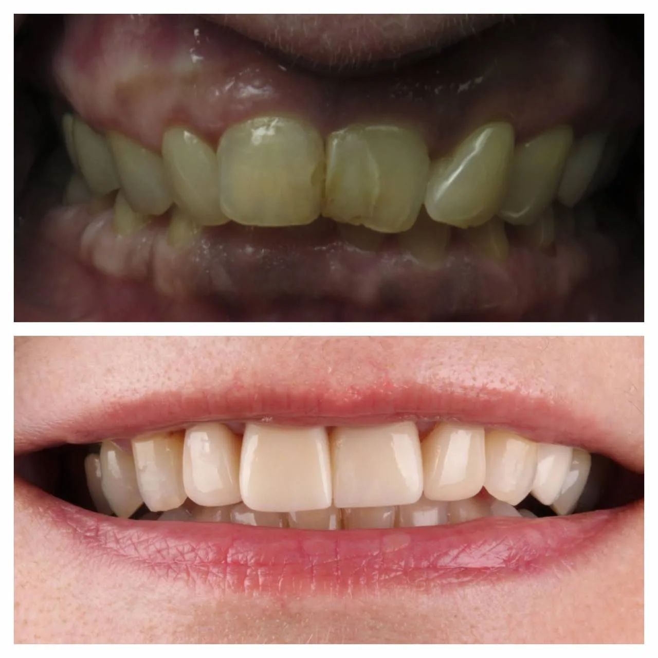 Same-day veneers — long-standing yellow staining, resolved in one visit.