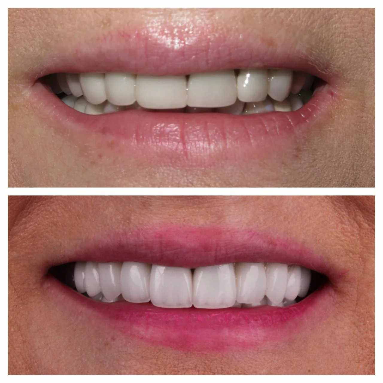 Case 10 — editorial macro portrait of veneer refresh case. Refreshed porcelain veneers, magenta lip, dark background. Photography by Dr. Koppelman, Midtown Manhattan.