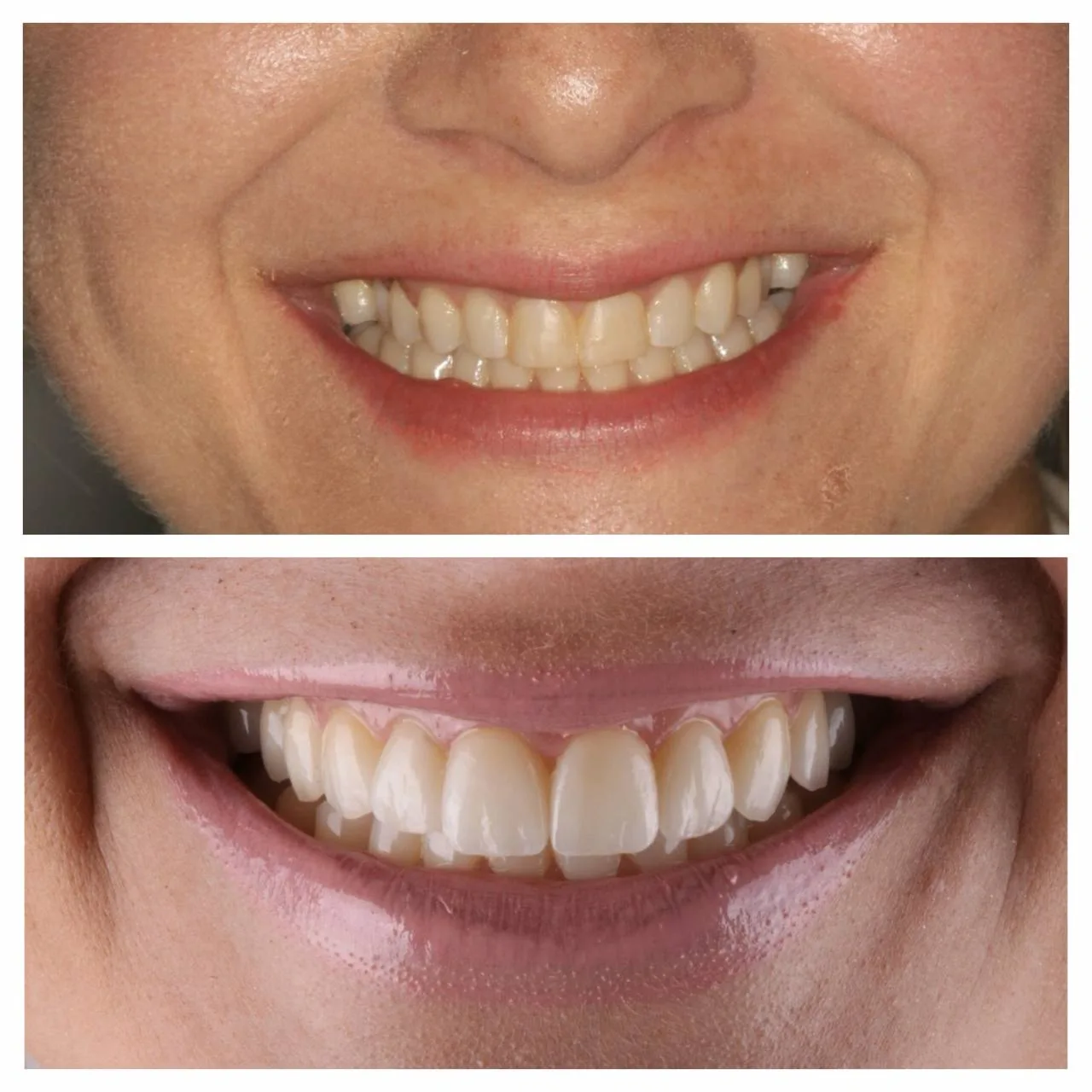Crooked teeth, straightened without orthodontics — before and after.